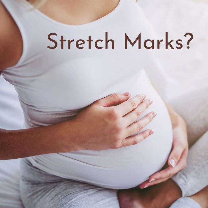 Stretch Marks Blog Image