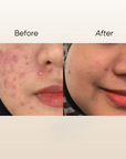 Rosa T Acne Serum