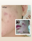 Rosa T Acne Serum