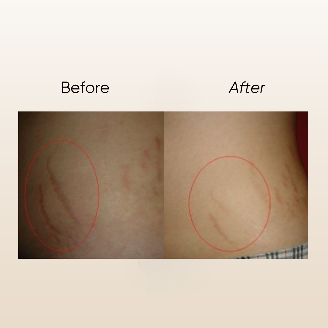 Jojo E Stretch Mark Serum 50ml (CLEARANCE SALE EXP: 11/2026)
