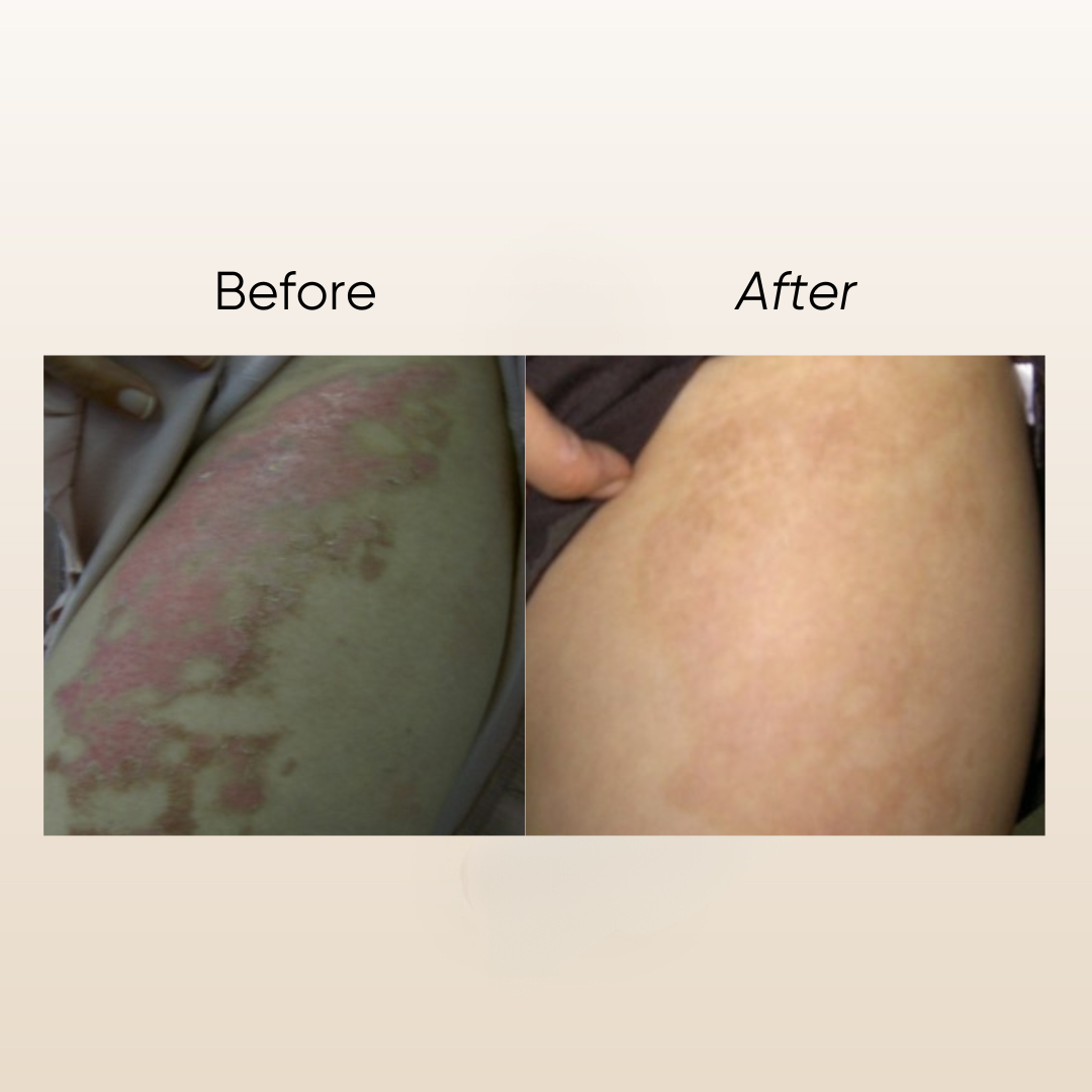 Natur E Scar Serum 5ml (CLEARANCE SALE EXP: 01/2027)