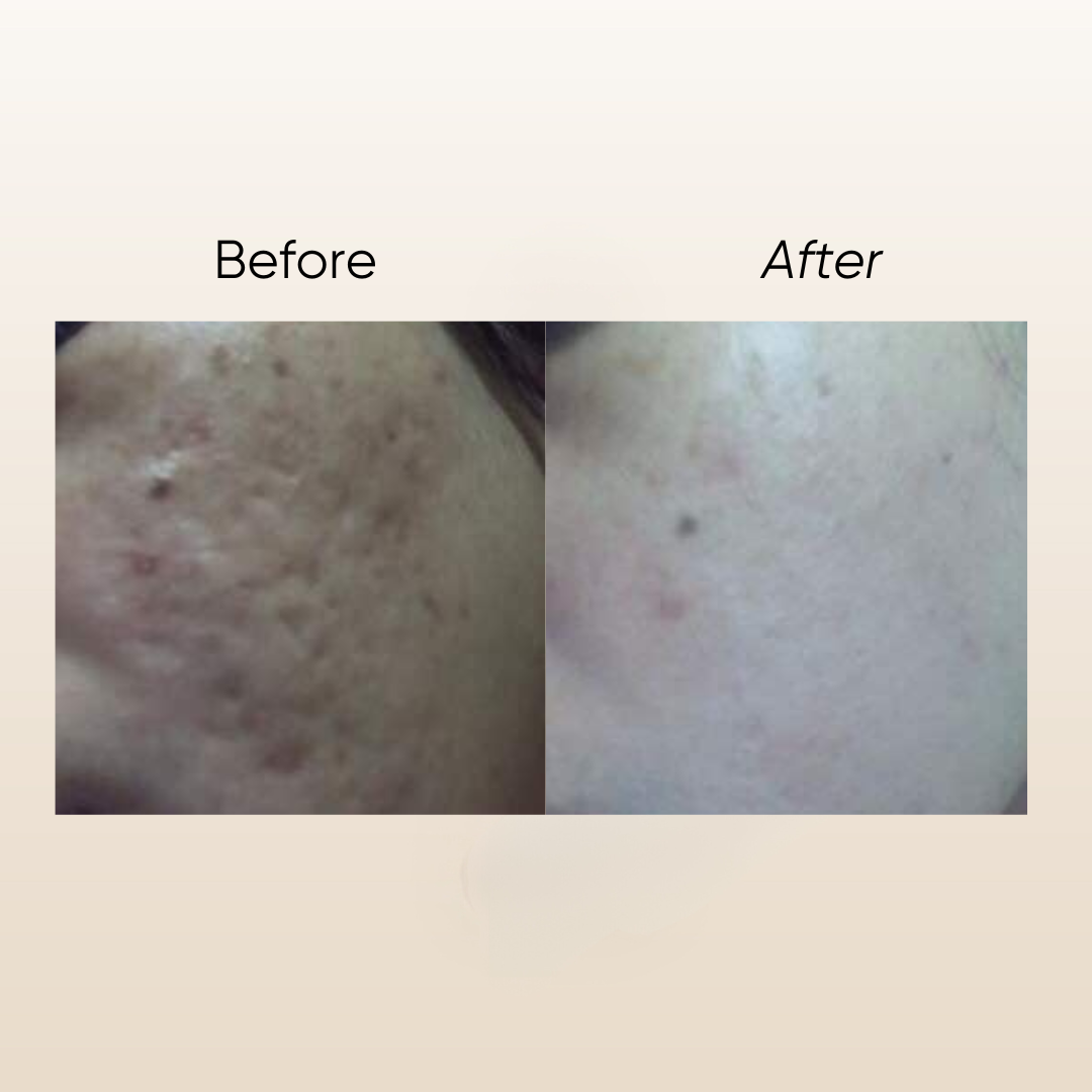 Natur E Scar Serum 5ml