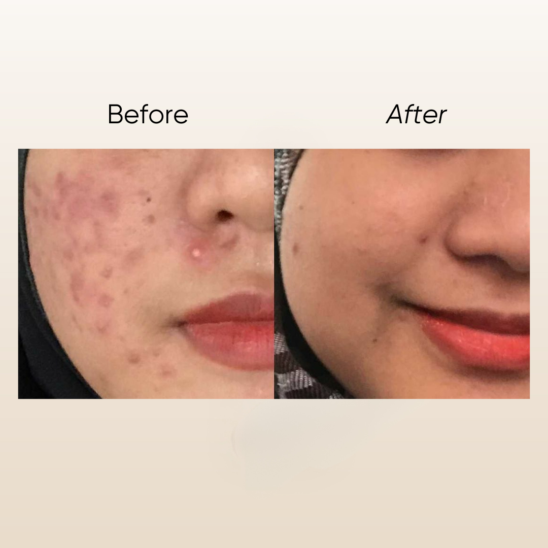 Rosa T Acne Serum 5ml