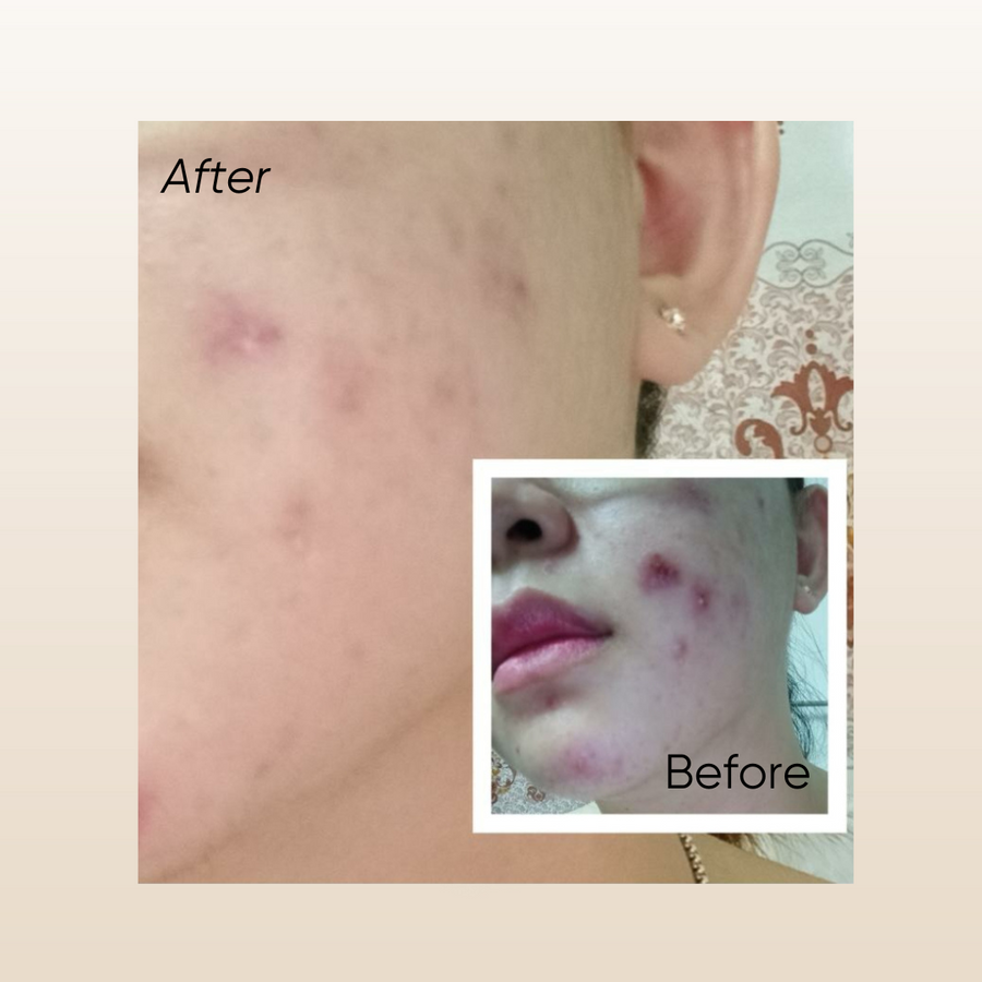 Rosa T Acne Serum 15ml